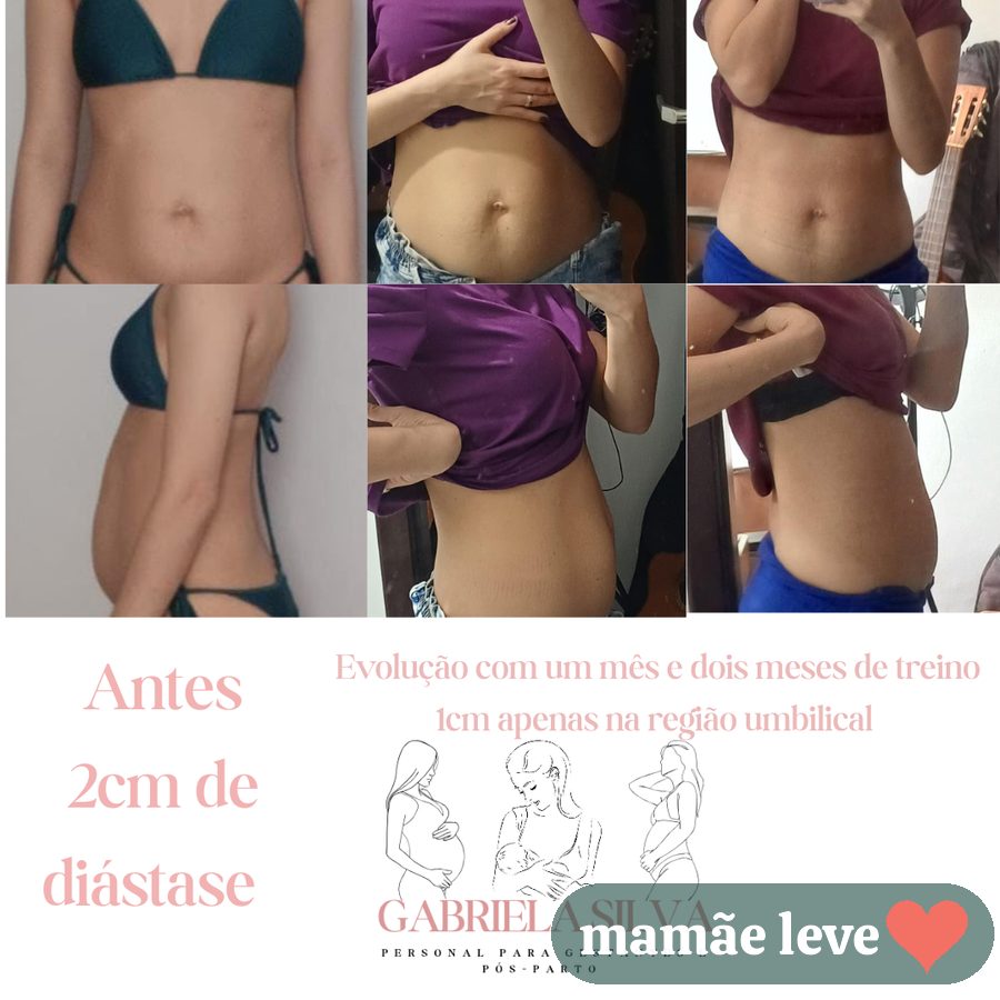 Evolução registrada: de 2 cm de diástase para 1 cm na região umbilical, com um e dois meses de treino